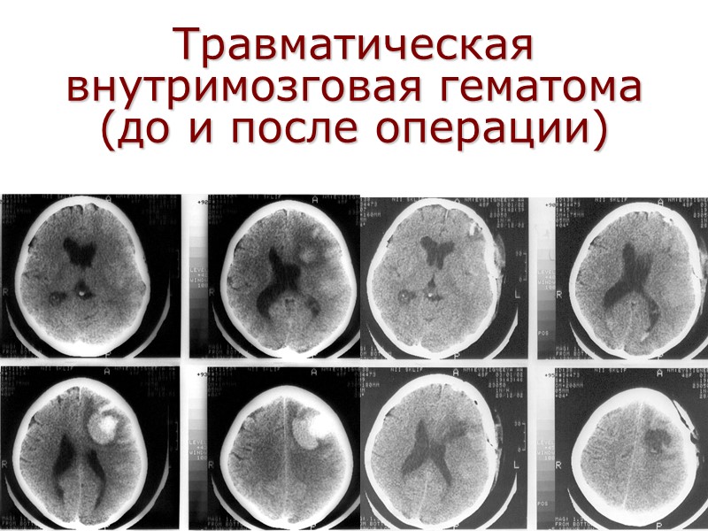 Травматическая внутримозговая гематома  (до и после операции)